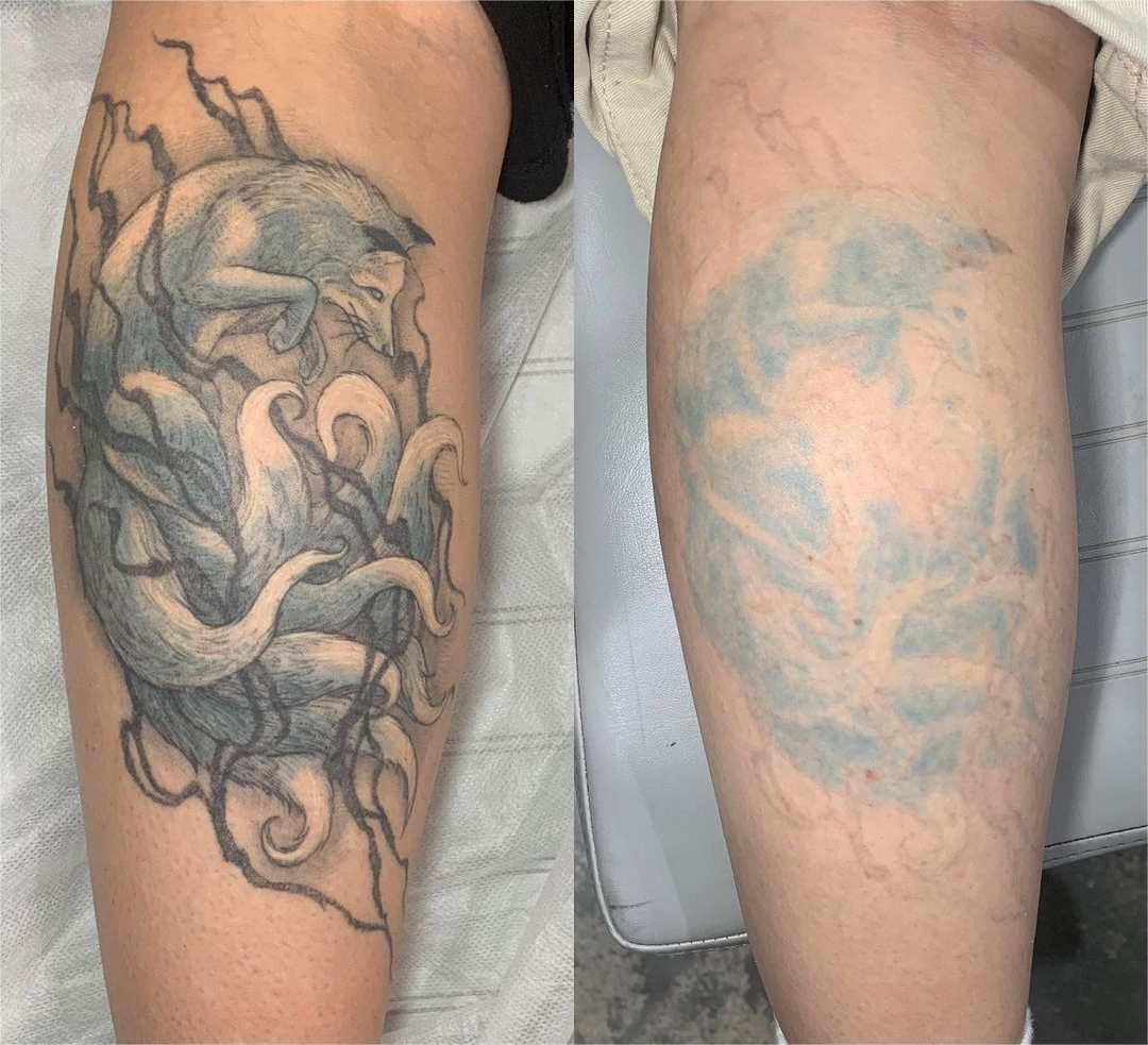 nd yag tattoo removal before and after