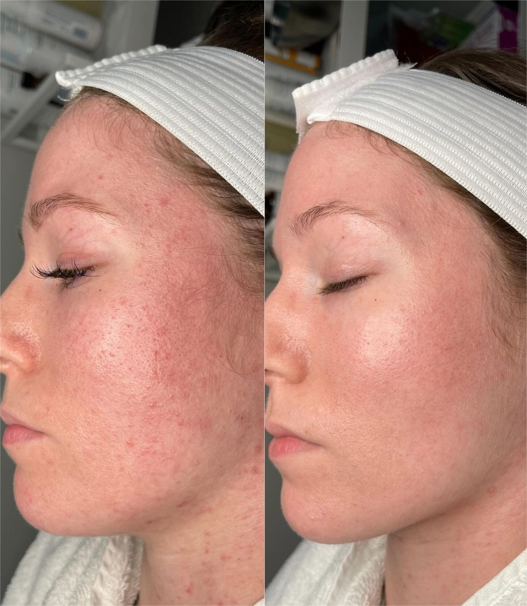 Acne treatment before and after comparison