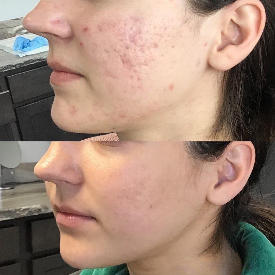 Comparison of microneedling results