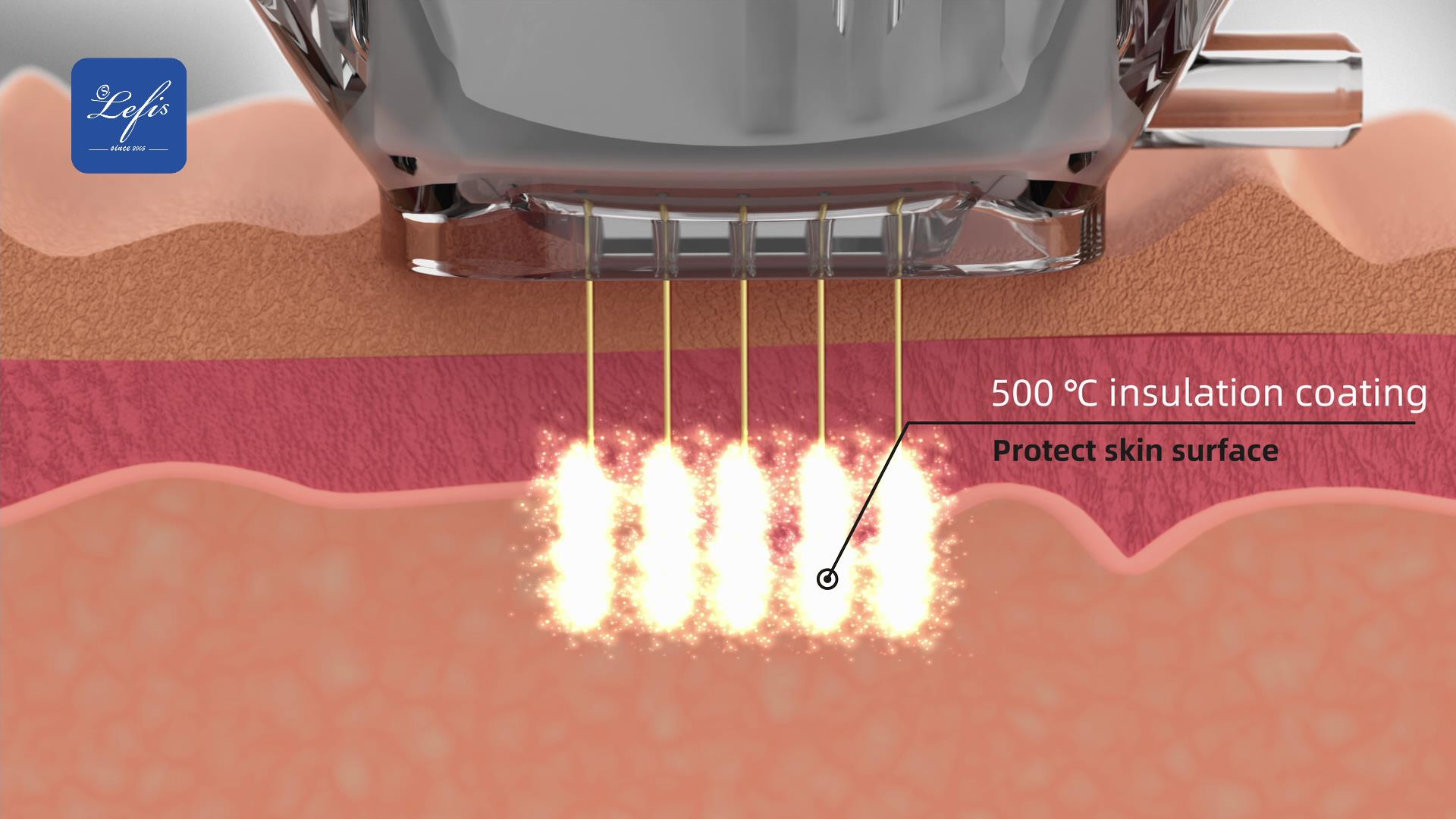 RF treatment principles