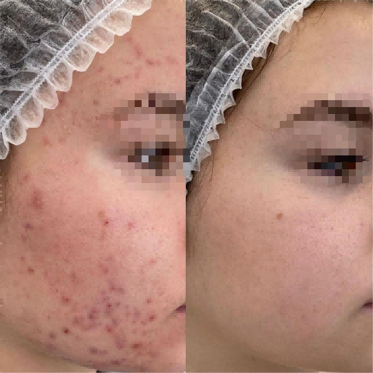 Before & After Acne Removal