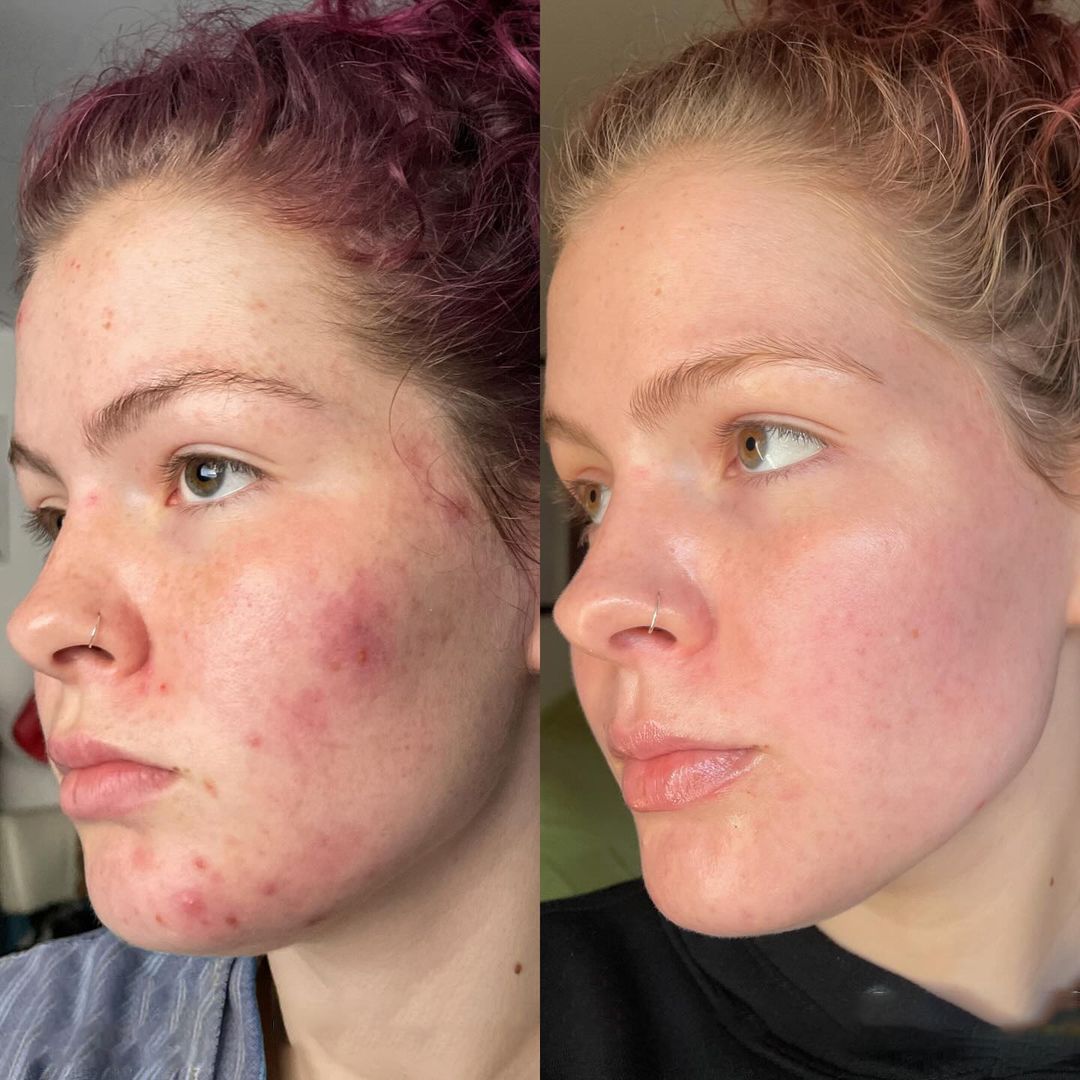 IPL before and after treatment