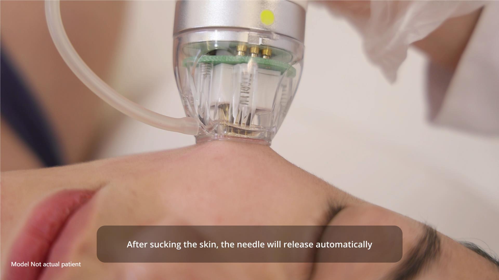 Microneedle Procedure