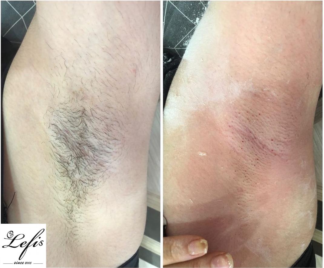 Hair Removal Before and After