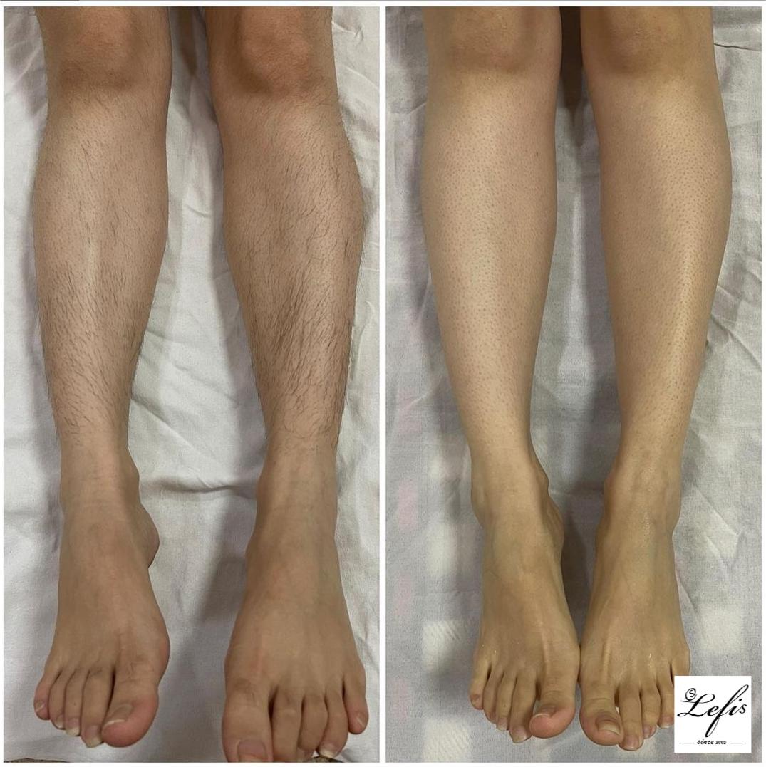 Hair Removal Before and After