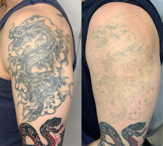 Tattoo Removal Before and After