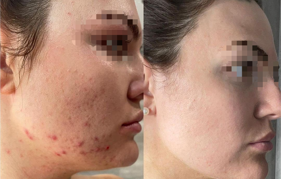 Before and after HIFU treatment