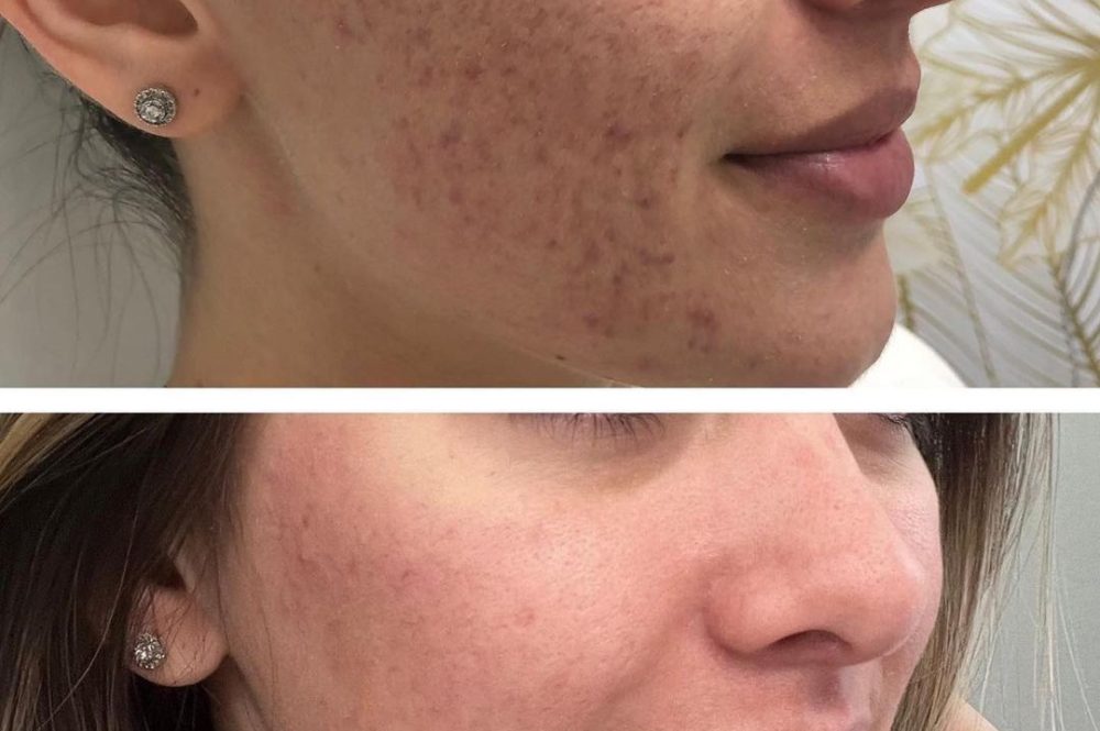 HIFU Acne Scars Before and After Treatment