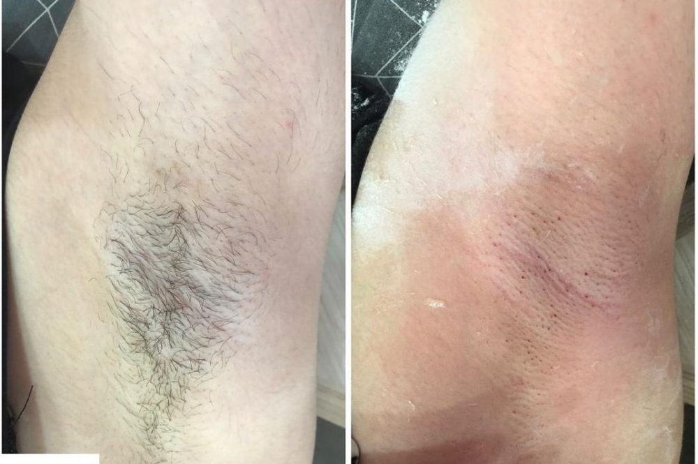 Hair Removal Before and After