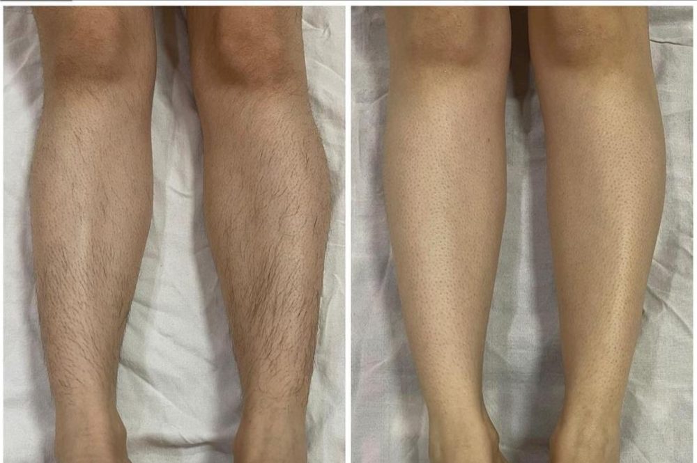 Hair removal before and after