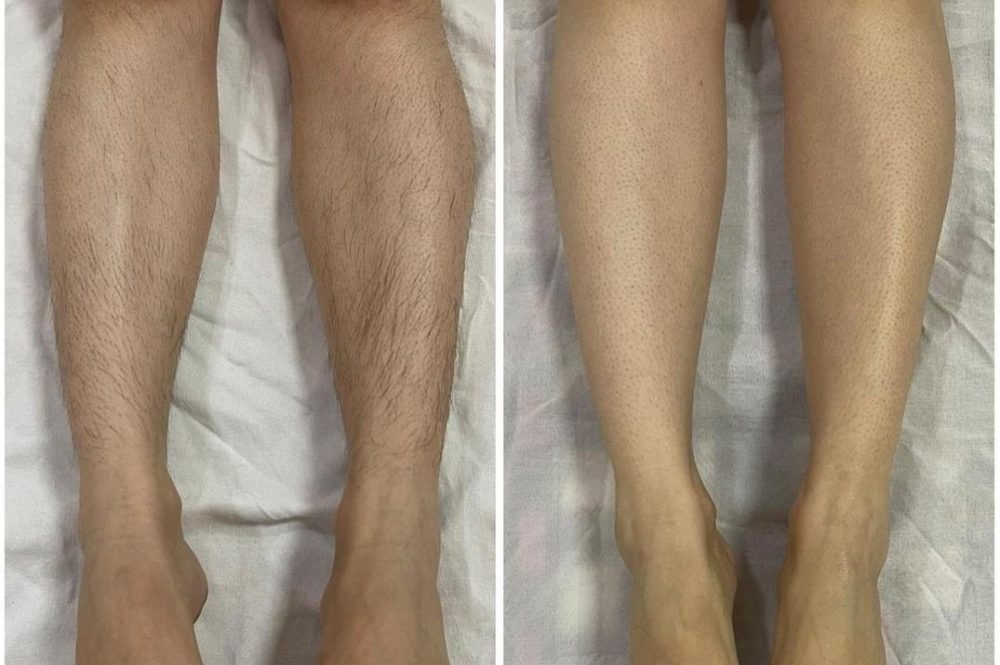 Hair removal before and after