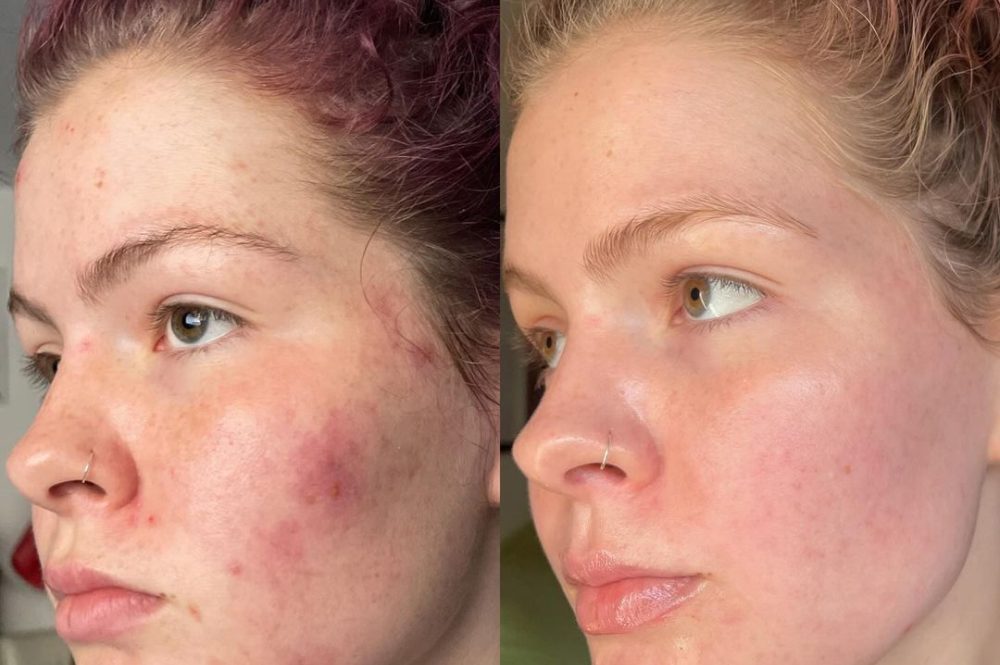Before and After Acne Removal